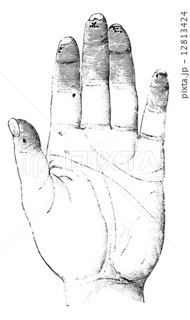 Sclerosis or Sclerotizis of the left hand (palmar surface), vint Sclerosis or Sclerotizis of the left hand (palmar surface), vint 12813424