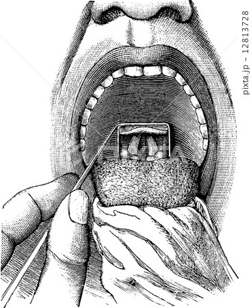 Laryngoscopy, vintage engraving 12813728