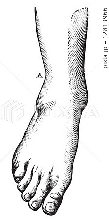 Fibula fracture with A highly charged, and a projection of the f 12813966