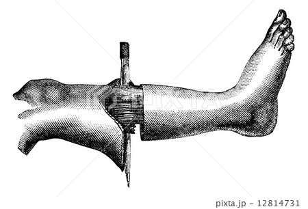 Amputation of the leg by the method has two flaps (circular inci 12814731