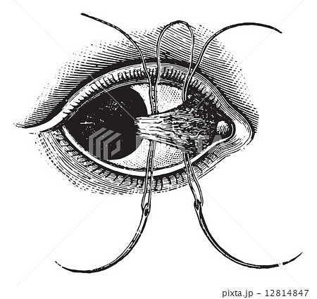 Ligation of pterygium, vintage engraving. 12814847