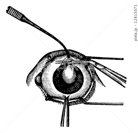 Iridectomy, vintage engraving 12815071