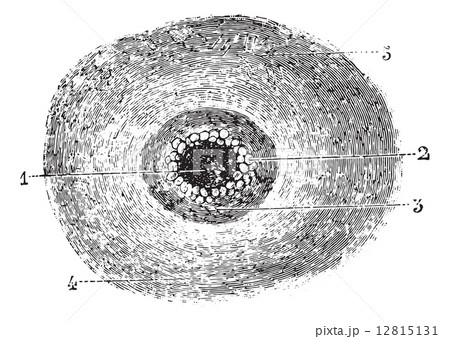 Malignant pustule or Anthrax, vintage engraving. Malignant pustule or Anthrax, vintage engraving. 12815131