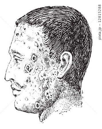 Human face infected with impetigo vintage engraving Human face infected with impetigo vintage engraving 12815288