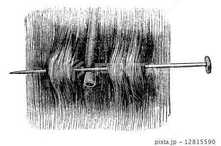 Acupressure with a single needle, vintage engraving. 12815590