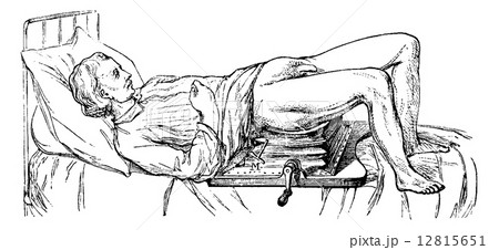 Subject operated on the device for lithotripsy, vintage engravin 12815651