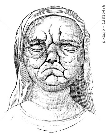 Leprosy or Hansen's Disease, vintage engraving 12816436