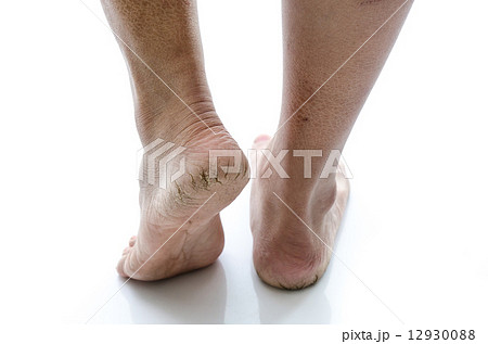 Close up of Cracks on Heels isolated 12930088