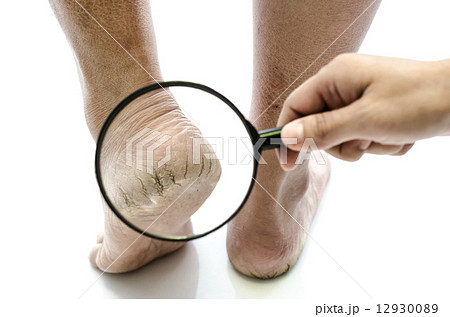 Close up of Cracks on Heels isolated 12930089