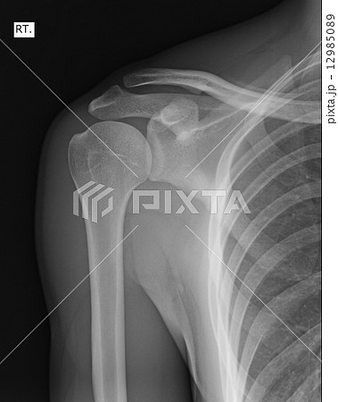 X-ray of human shoulder 12985089