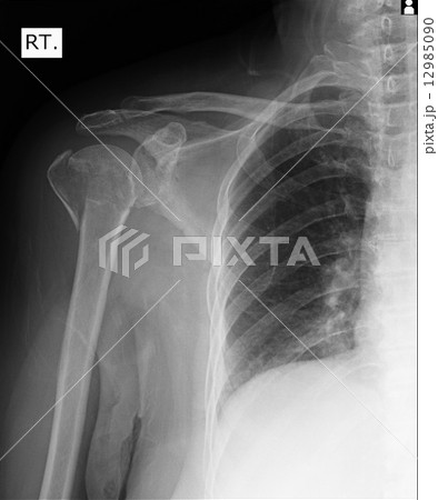 X-ray of human shoulder 12985090