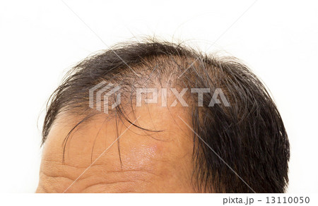 Male head with hair loss symptoms front side Male head with hair loss symptoms front side 13110050