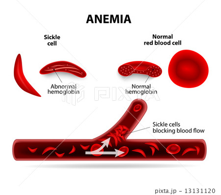 anemia 13131120