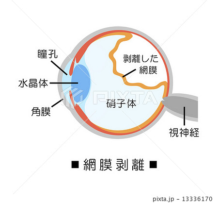 網膜剥離 13336170