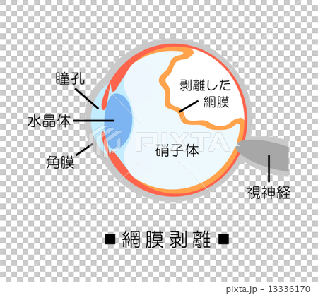 網膜剥離 13336170