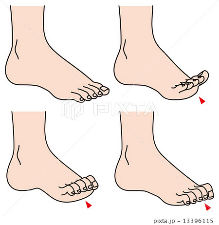 足の指のトラブルのイラスト素材 13396115 Pixta