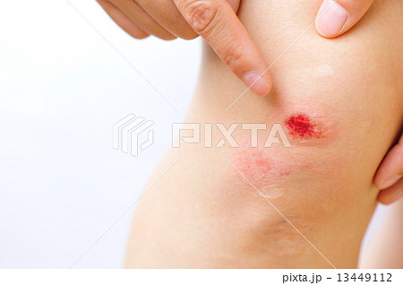 sports injured knee  13449112