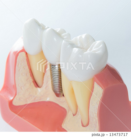 Dental implant 13473717