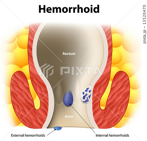 Hemorrhoids 13520470