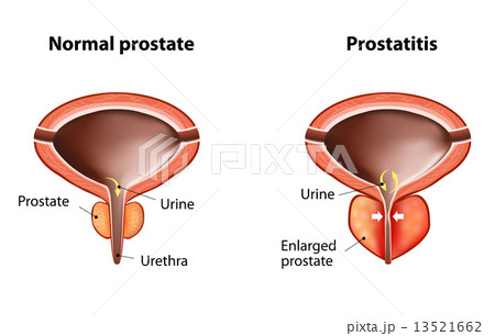 Prostatitis 13521662