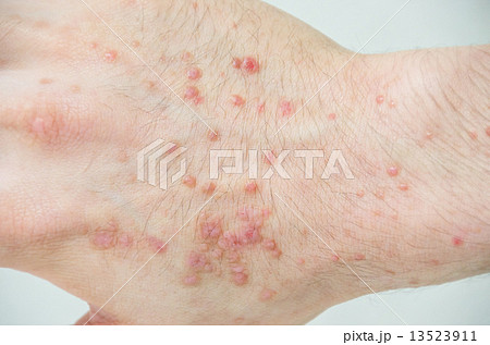 肌荒れした手 13523911