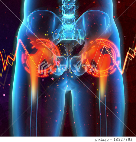 3d rendered medical illustration of a painful femur 13527392