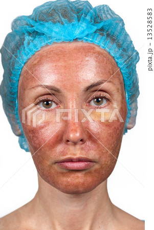Cosmetology. Skin condition after chemical peeling TCA. person full face Cosmetology. Skin condition after chemical peeling TCA. person full face 13528583