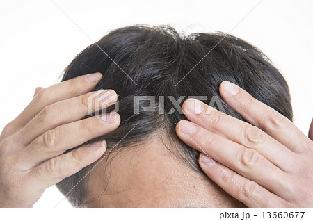男性の頭皮　 13660677