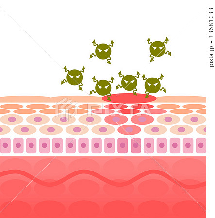 細菌感染のイラスト素材