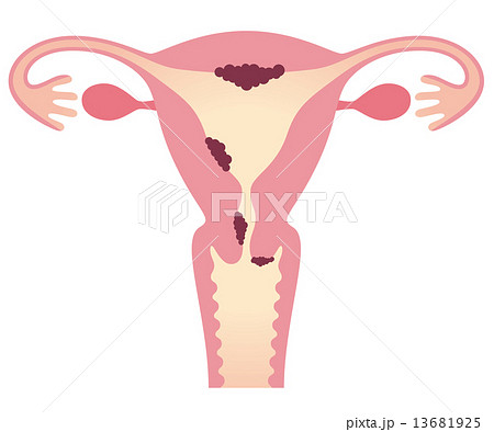 子宮がん 女性のからだのイラスト素材