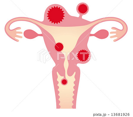子宮筋腫 女性のからだのイラスト素材 [13681926] - PIXTA