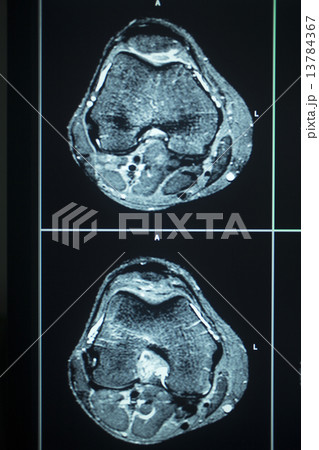 MRI scan test results knee meniscus injury MRI scan test results knee meniscus injury 13784367