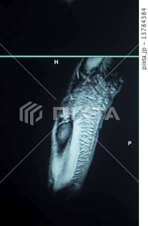MRI scan test results foot toes injury 13784384