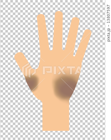Bruise of hands Bruise of hands 13807597
