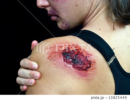 open wound on woman shoulder open wound on woman shoulder 13825449