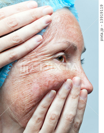 Cosmetology. Chemical peeling. "Parchment" skin before rejection. Cosmetology. Chemical peeling. "Parchment" skin before rejection. 13919119