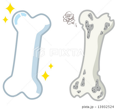 健康な骨と弱い骨 13932524