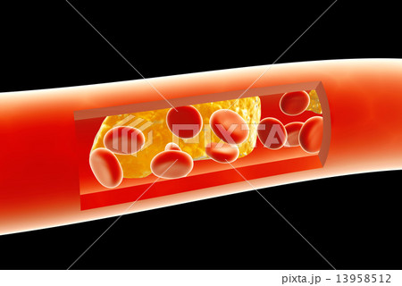 Atherosclerosis Atherosclerosis 13958512