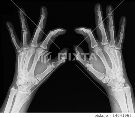X-ray of hands 14041963