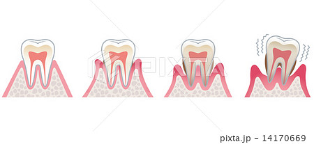 歯の断面図 歯周病 歯の断面図 歯周病 14170669