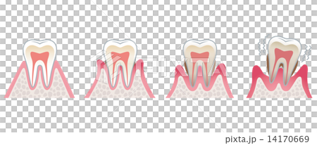 歯の断面図 歯周病 歯の断面図 歯周病 14170669