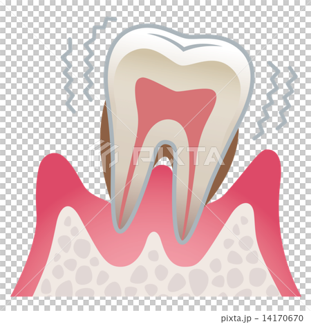 Sectional view of teeth Periodontal disease 14170670