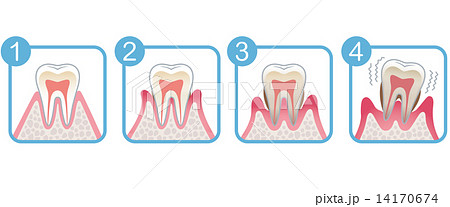 歯の断面図 歯周病のイラスト素材 14170674 Pixta