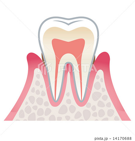 歯の断面図　歯周病 14170688
