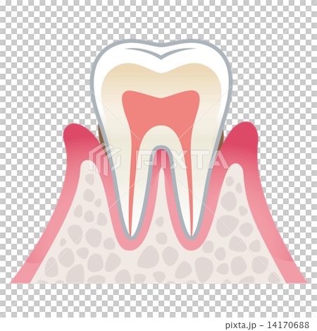 歯の断面図　歯周病 14170688