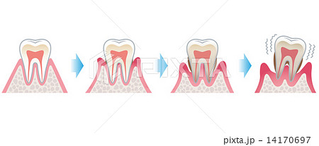 歯の断面図 歯周病のイラスト素材