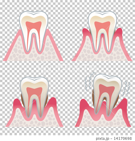 牙齒牙周病的剖面圖 14170698
