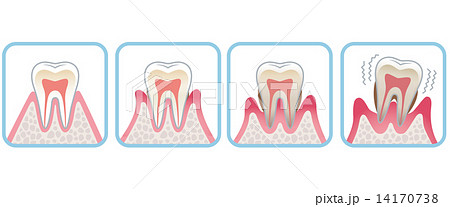 歯の断面図 歯周病のイラスト素材