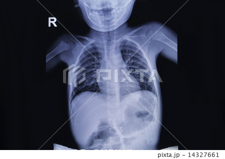 Chest x-ray of children 14327661