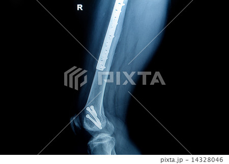x-ray image of fracture leg ( femur )with implant plate and scre x-ray image of fracture leg ( femur )with implant plate and scre 14328046